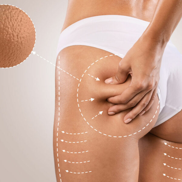 Anti-cellulite massage