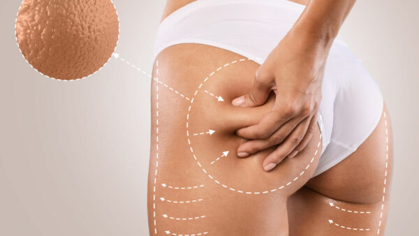 Anti-cellulite massage
